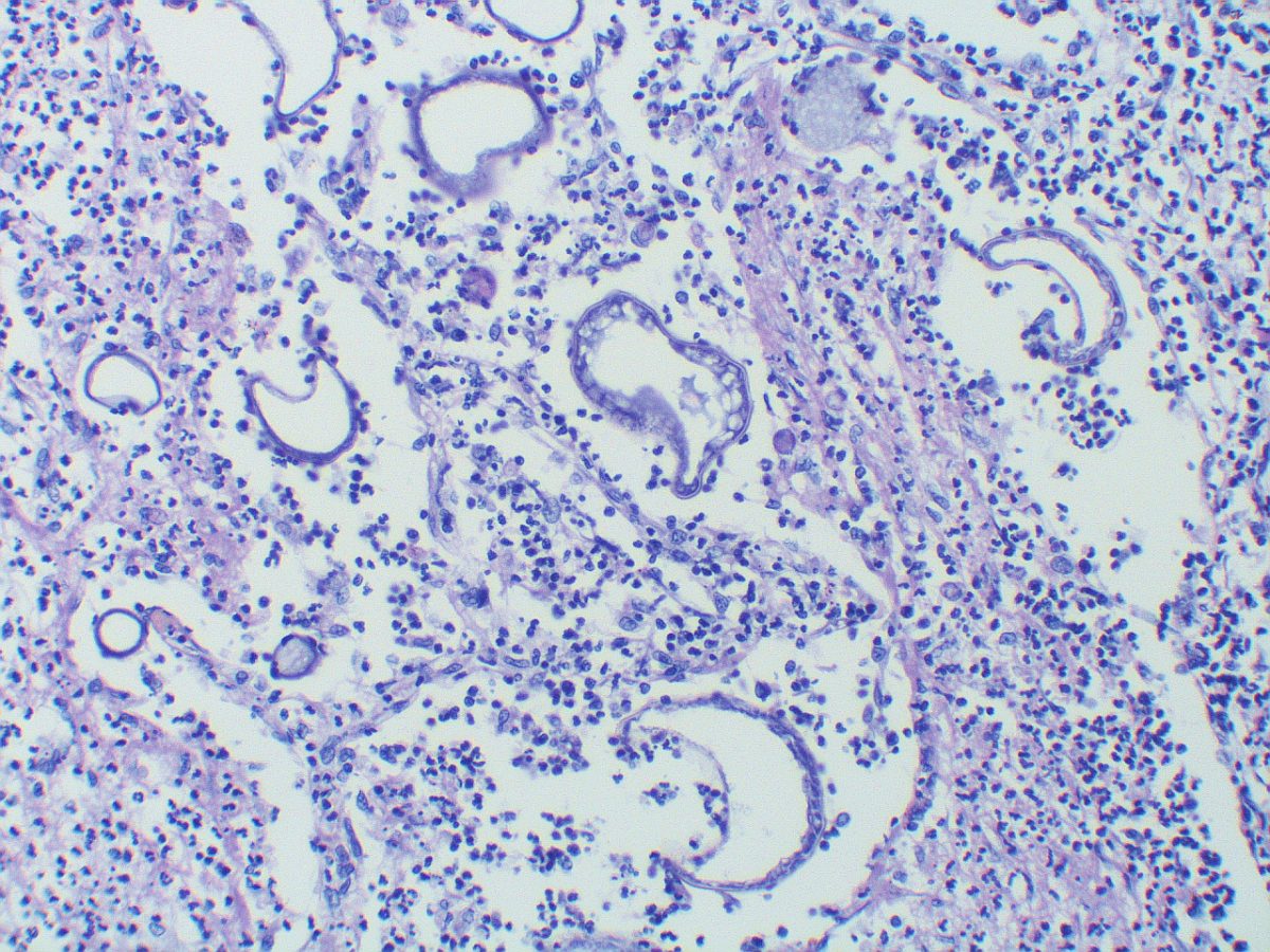 An example of the damage Valley Fever does to the body—Spherules that have ruptured and are now empty and in various stages of collapse.